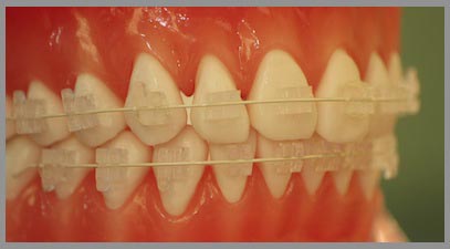 photo of ceramic braces