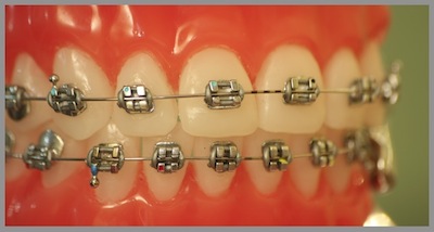 photo of metal braces